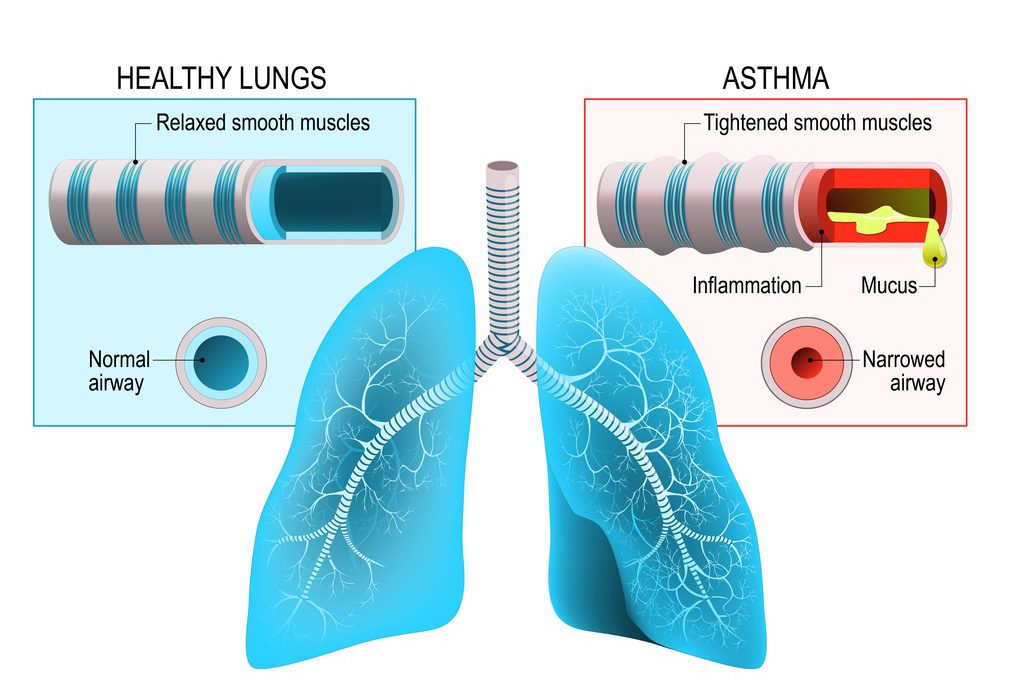 What is Allergic Asthma? | Causes, Symptoms, and More – Allergies Info