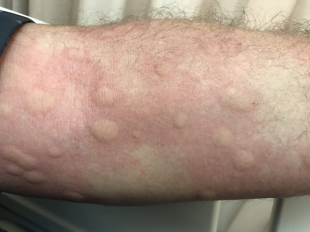 Urticarial rash from Drug Allergy.