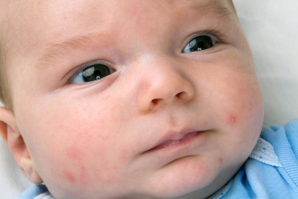 Acne on the Chin, a baby with pimples on the cheeks.