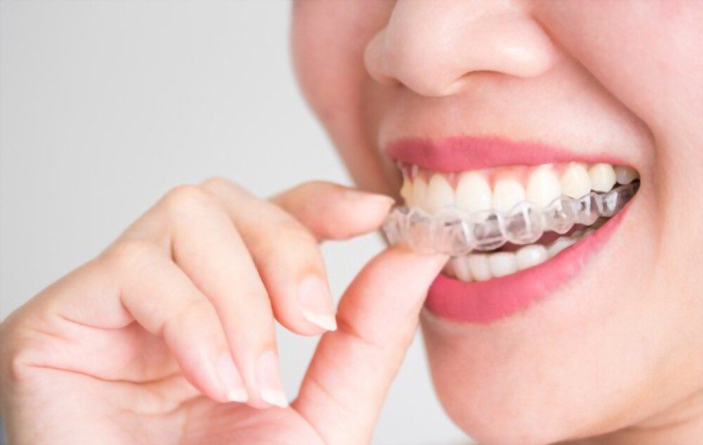 Do you have Invisalign Allergy? A smiling woman holding Invisalign or invisible braces,