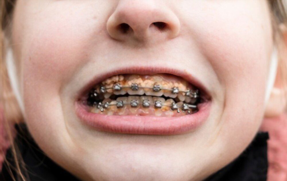 Dirty braces after eating food without cleaning. If you are not Brushing Teeth with Braces your teeth can be like this.