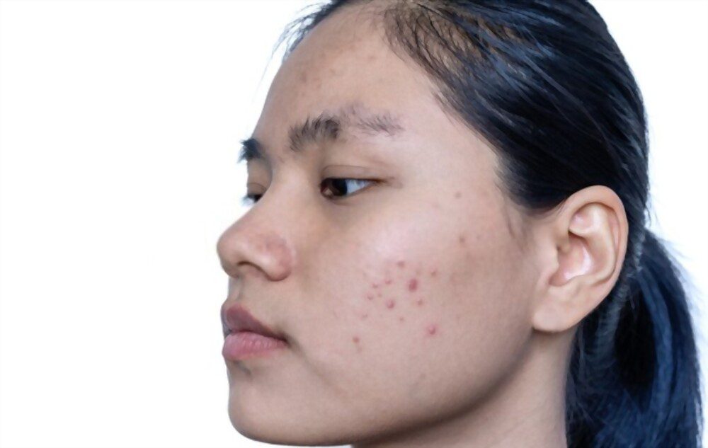 Close up of young Asian woman worry about her face have acne on chin and jawline.