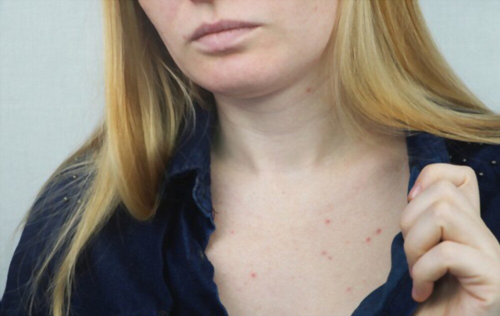 Young woman with acne on the chest.