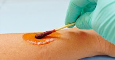 Iodine Allergy - the doctor is applying iodine on a white arm scar.