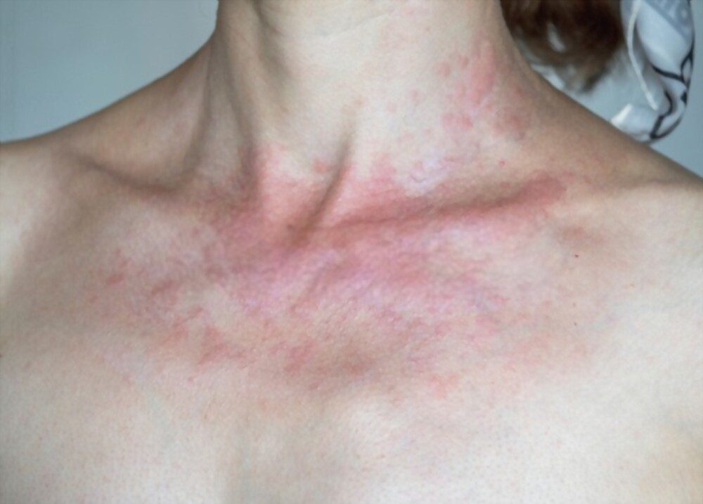 A woman has burned skin caused by solar dermatitis.