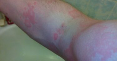 Urticaria pigmentosa on arm.