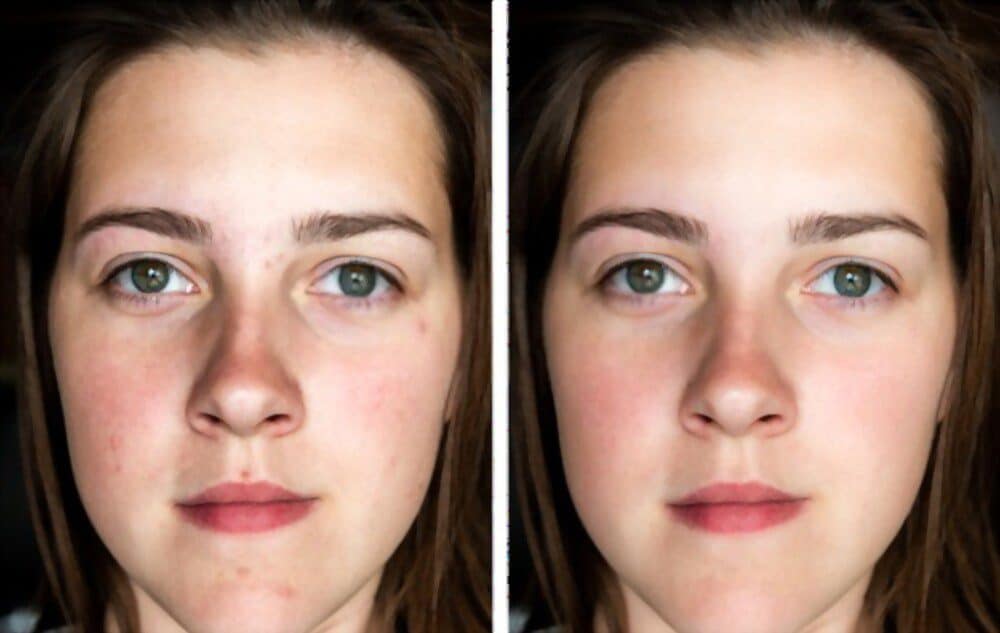 Before and after Bermuda dark spot treatment