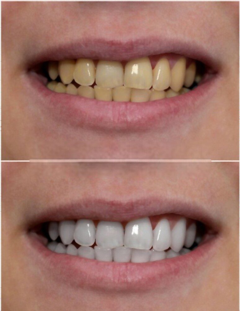 Yellow dirty teeth before and after the teeth whitening treatment.
