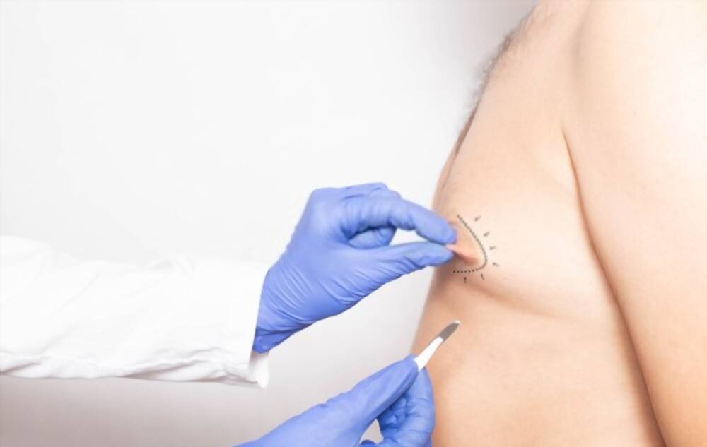 Gynecomastia Pinch Test (diagnosis)