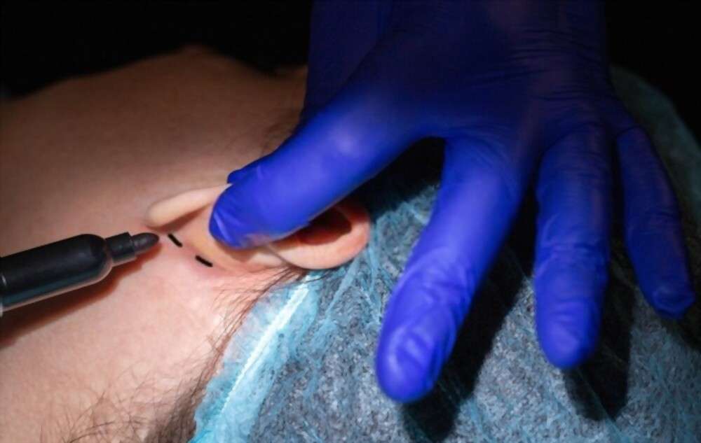 The surgeon is drawing labels under the ear for otoplasty purpose.