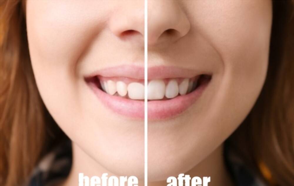 Tooth Contouring before and after