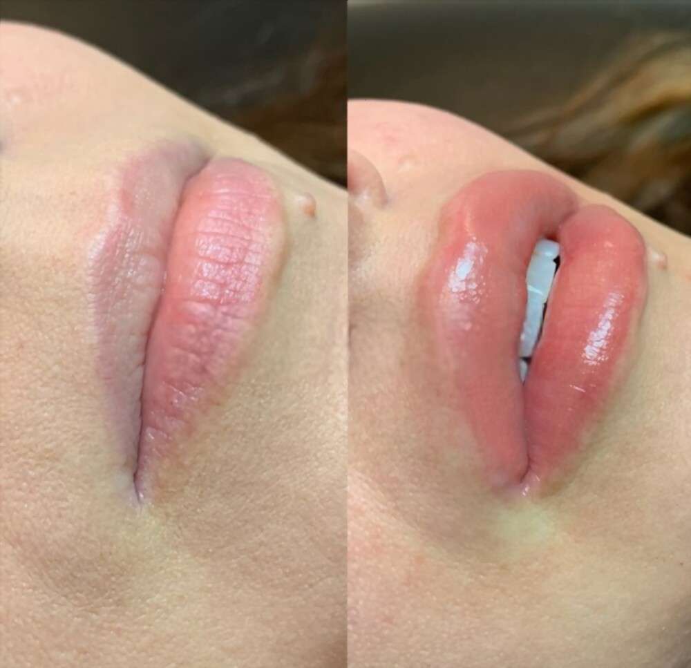 lip neutralization before and after