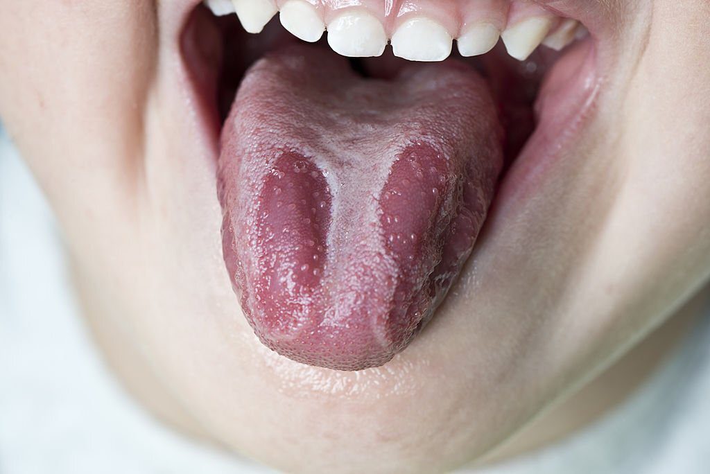 A boy has a burnt tongue due to consuming something hot.