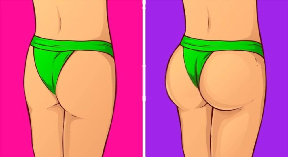 A vector illustration of butt implants before and after surgery.